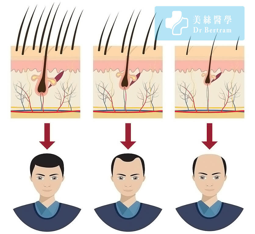 毛髮萎縮進程