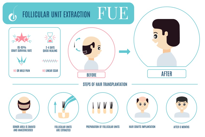 FUE extraction diagram
