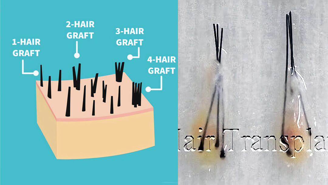 Microscopic diagram of a follicular unit showing hair shafts, sebaceous gland, and arrector pili muscle