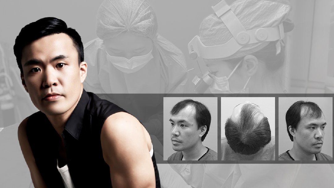 FUE technique performed in a single day