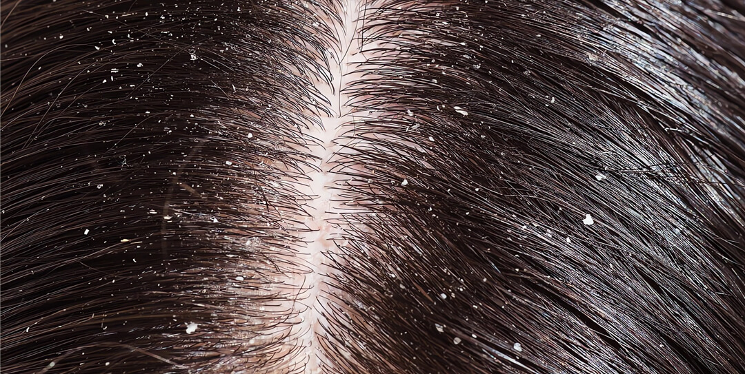 Scalp Psoriasis and Seborrheic Dermatitis