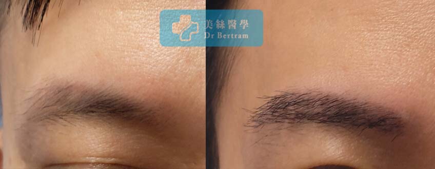 臨床個案：男性稀疏眉毛修復