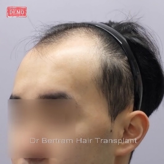 術前：稀疏頭髮下頭皮可見