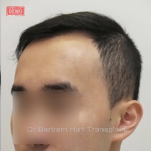 術後12個月：密度改善