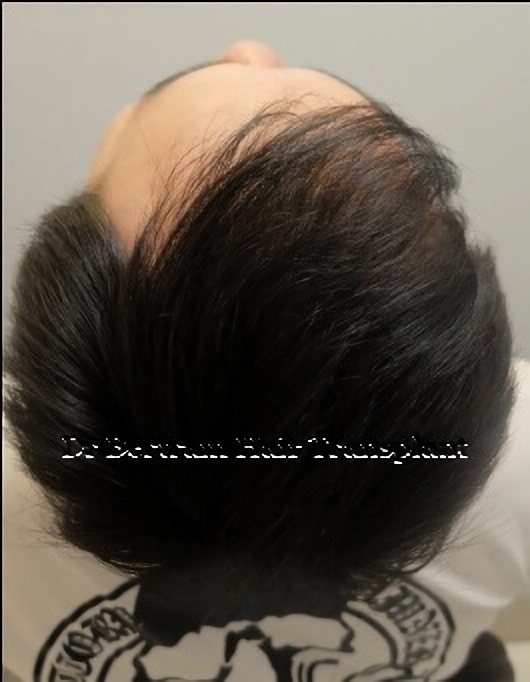 術後12個月：右側角度