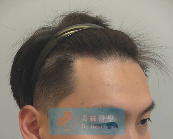 術後：覆蓋改善