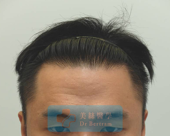 術後：自然密度