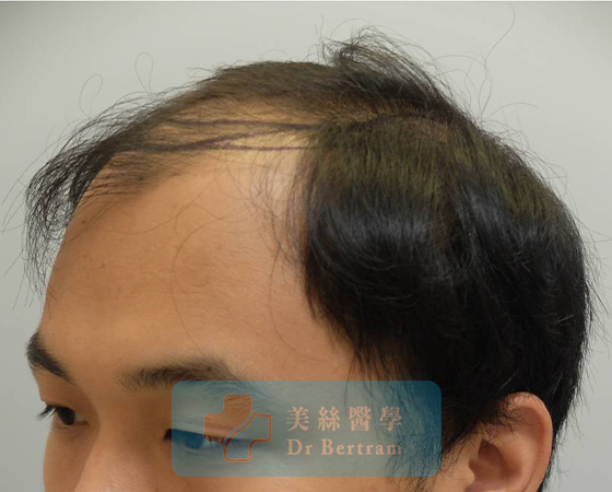 術前：頭頂中部可見稀疏