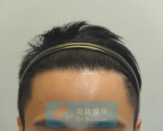 術後12個月：髮際線恢復
