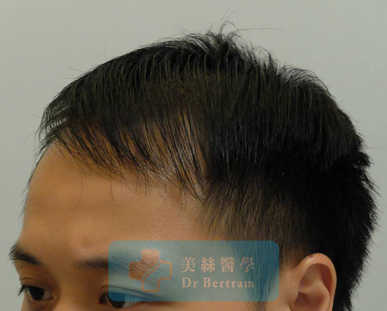 術後：覆蓋改善