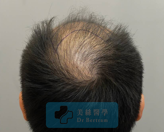 術前：右側可見後移