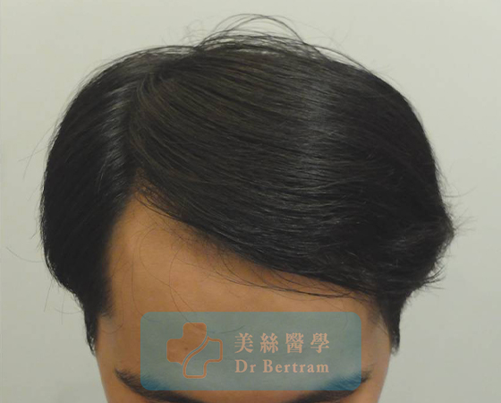 術後12個月：髮際線恢復