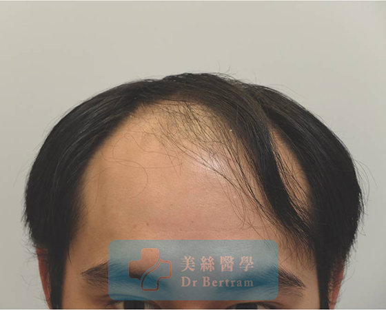 術前：頭頂中部可見稀疏