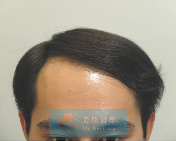 術後：覆蓋改善