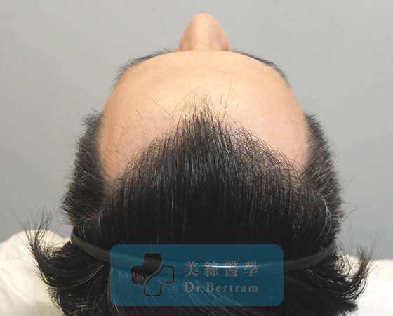 術後：自然密度