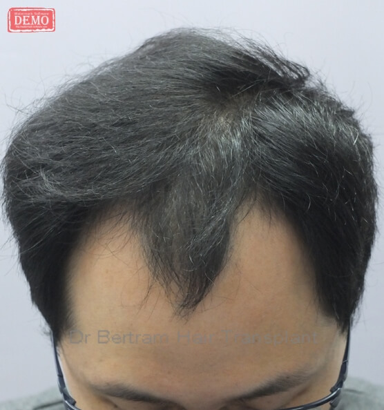 術前：正面角度，V期脫髮模式