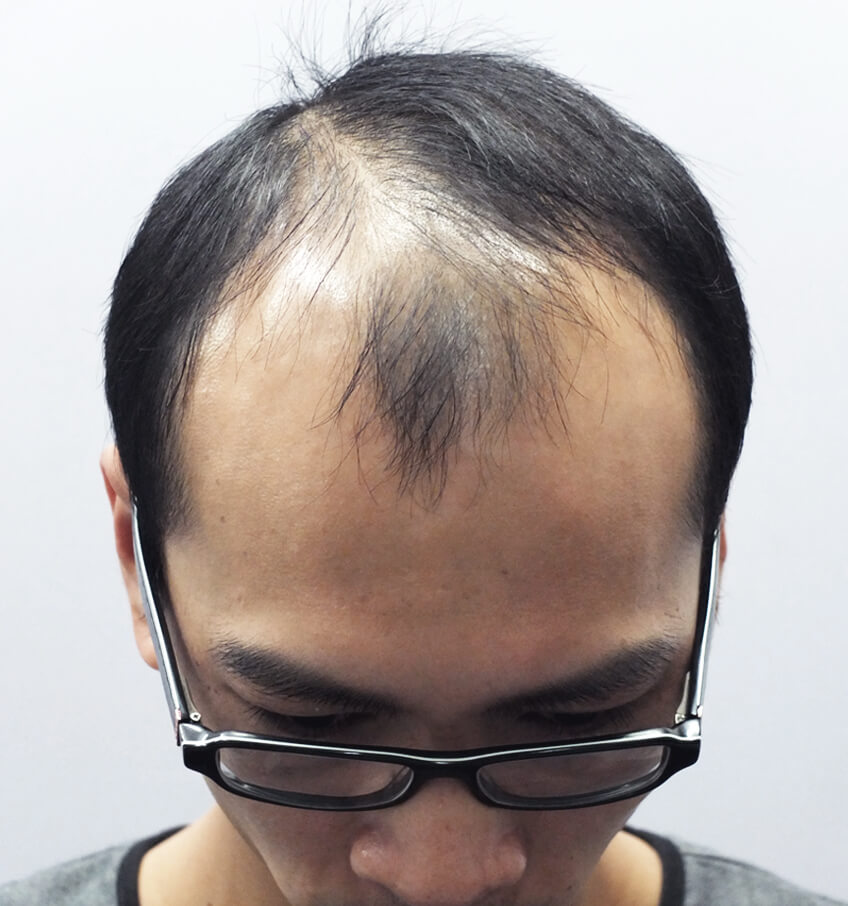 術前：右側角度