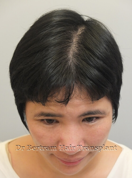 12 months post-procedure