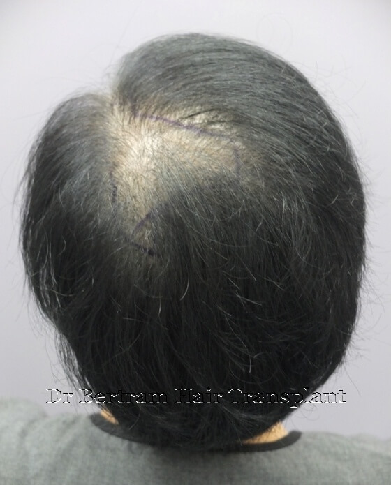 個案2 女性術前：頭頂角度顯示廣泛性稀疏