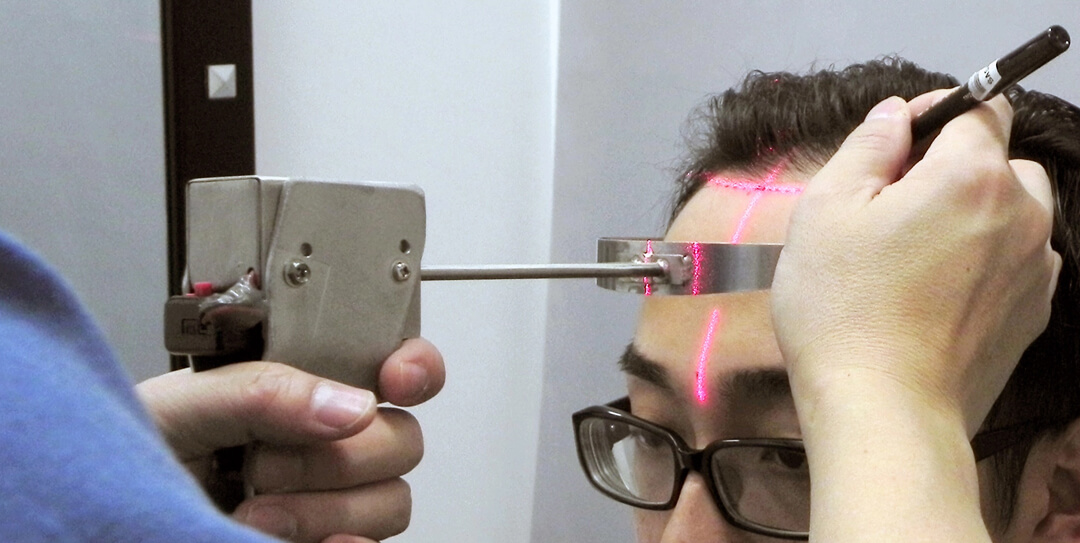 Handheld laser device for hairline placement, 2008