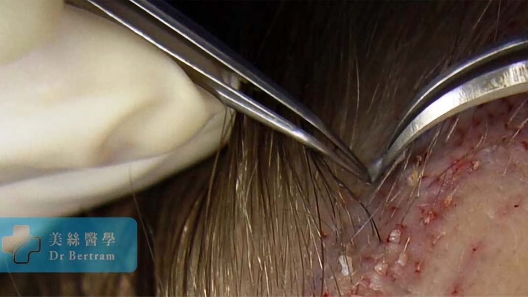 Graft implantation
