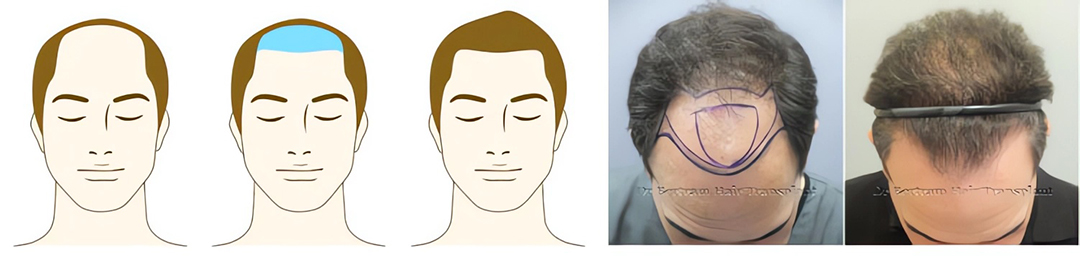 Norwood Class IV hair loss